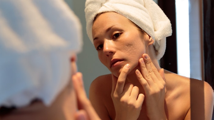 young woman looking her acne scars on the mirror