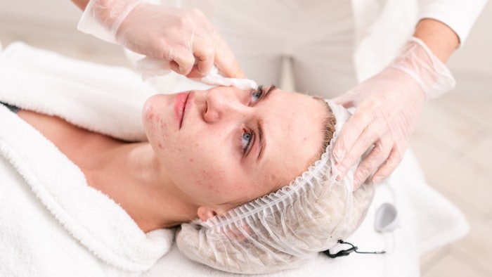 Acne Spa Treatment