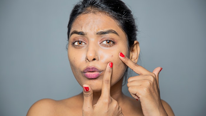 Woman with Acne