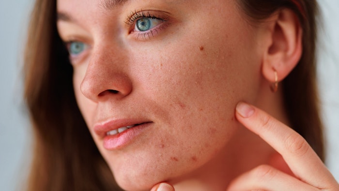 Adult Acne