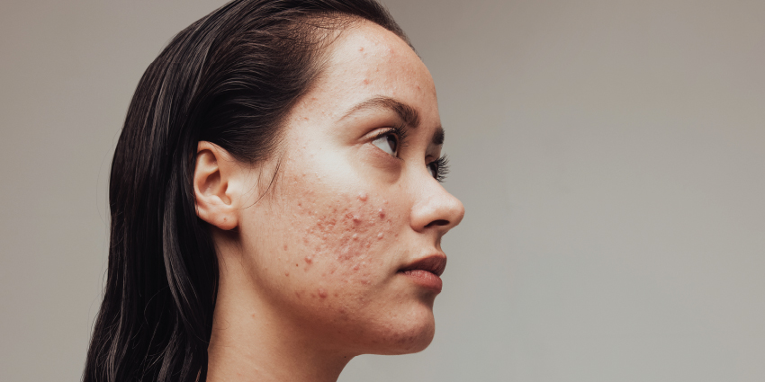 Protocols in Practice: Acne