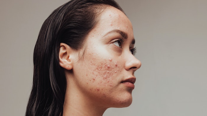 Protocols in Practice: Acne