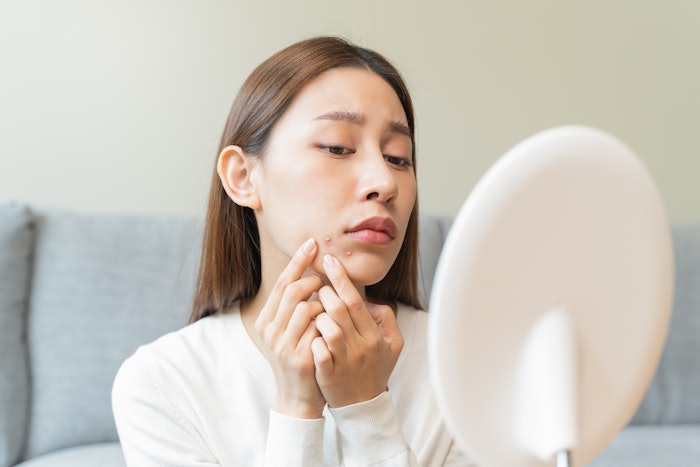 Asian young woman worry about acne on her face after wear face mask.