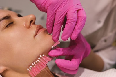 Threads placed along jawline