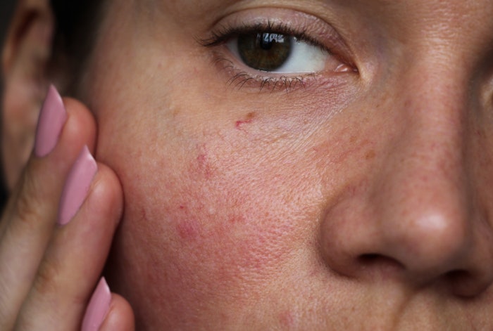Lead scientist of luxury brand reveals recent findings that may shape the future of inflammation skin care products.