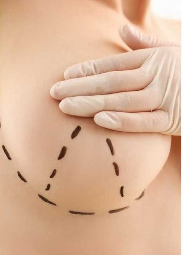 Newly FDA approved Motiva Implants offer a safer alternative for breast enhancement procedures, demonstrating notably reduced rates of complications.
