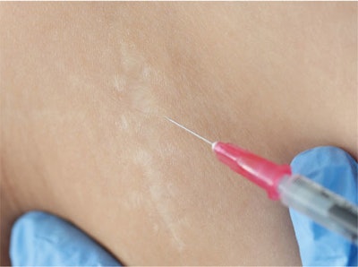 Subcision and dermal fillers treatments for depressed scars.