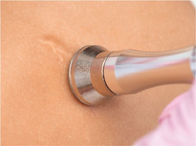 Ultrasound therapy for targeting deep scar tissue.