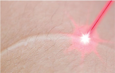 Laser therapies are widely used for scar revision.