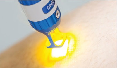 CO2 laser treatment for scar revision.