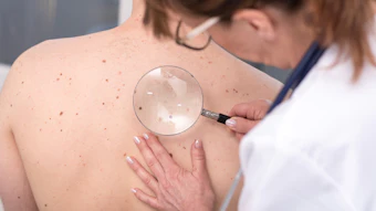 Doctor looking at potential skin cancer