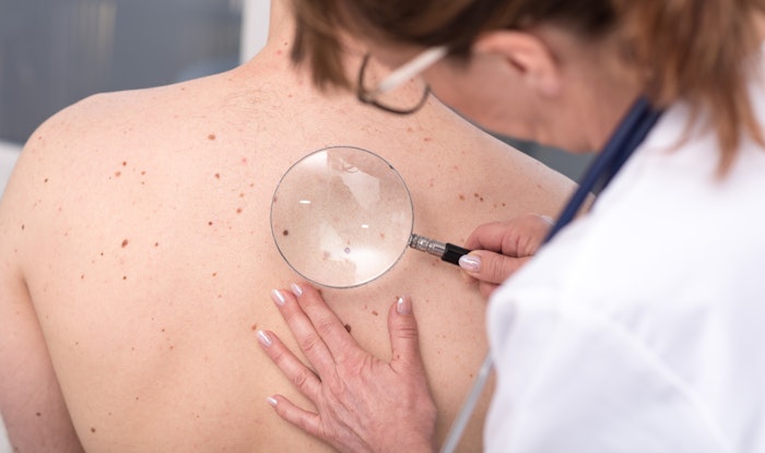 Doctor looking at potential skin cancer