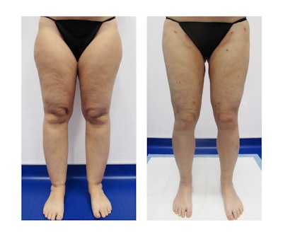 Lipo360, specifically for the legs, targets the entire circumference, including the thighs, inner thighs and outer legs, creating a more balanced shape.