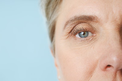 Thinning skin and wrinkles occur as the eyes age. The thin skin becomes more fragile, increasing the visibility of blood vessels and fine lines.