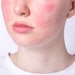 April is Rosacea Awareness Month, a month dedicated to educating the public on this chronic facial skin disorder.
