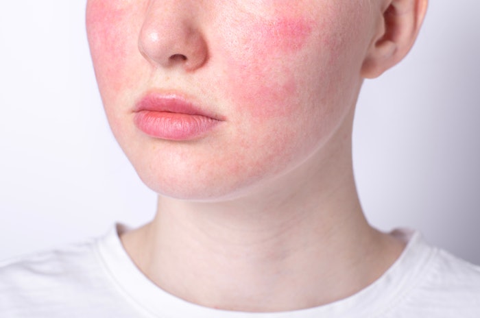 April is Rosacea Awareness Month, a month dedicated to educating the public on this chronic facial skin disorder.