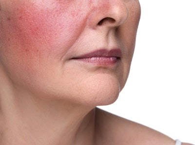 The NRS says the most common sign of the disease is persistent redness on the central part of face: the cheeks, nose, forehead and chin.