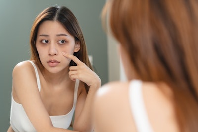 Dark circles around the eyes are a common aesthetic concern that affects people of all ages and skin types. Discoloration under the eyes can make people look tired, older or even sick. To know how to treat the skin correctly in this area, you must first look at the cause.