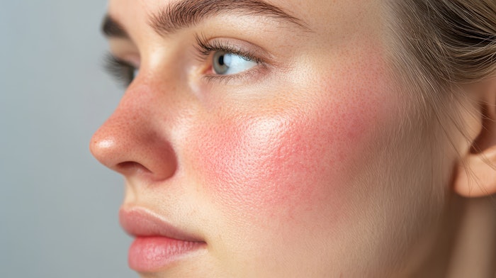 Neurotoxins, long recognized for their ability to smooth dynamic wrinkles, are now emerging as a groundbreaking treatment for inflammatory skin conditions.