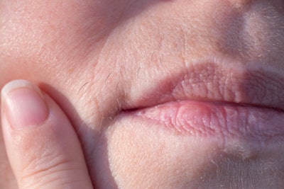 Unlike laser hair removal, electrolysis is not limited by skin tone or hair color, which is particularly important for those with PCOS, as facial hair may range in color and thickness