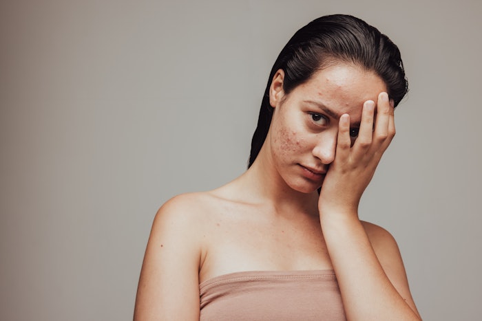 Managing pre-acne skin is about striking the right balance for each individual.