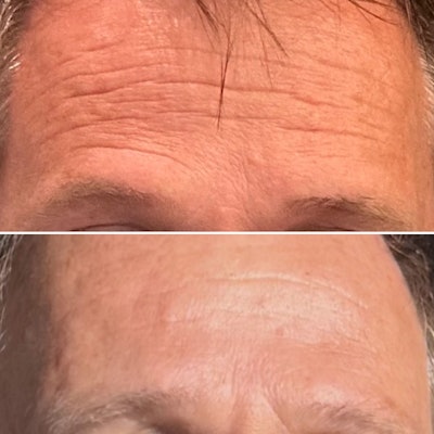 Bioquantine can help reduce the appearance of wrinkles.