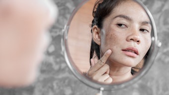 Melasma presents as dark patches on the skin, often on the cheek, forehead or upper lip areas.