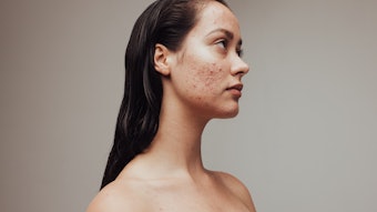 Building skin resilience while managing acne means dealing with inflammation and strengthening the skin barrier.