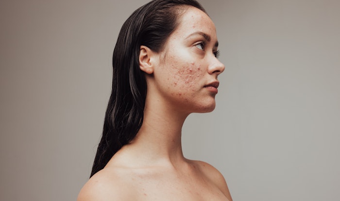 Building skin resilience while managing acne means dealing with inflammation and strengthening the skin barrier.