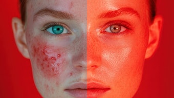 Managing acne requires treating the individual causes, rather than just the symptoms.
