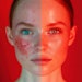 Managing acne requires treating the individual causes, rather than just the symptoms.