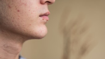 The Sebio 4 Molecule Serum is in high-demand for its ability to help manage acne lesions.