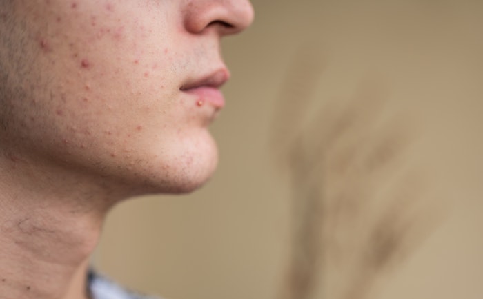 The Sebio 4 Molecule Serum is in high-demand for its ability to help manage acne lesions.