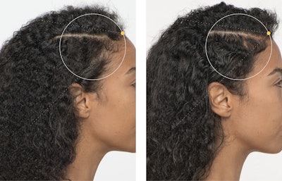 While everyone’s experience is different, clients can expect to see visibly thicker, stronger and faster-growing hair with 3-6 months of consistent use of the Hair Growth Nutraceuticals.