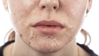 Chemical peels are a staple in skin care, but the kind of peel and your technique all comes down to your client's needs.