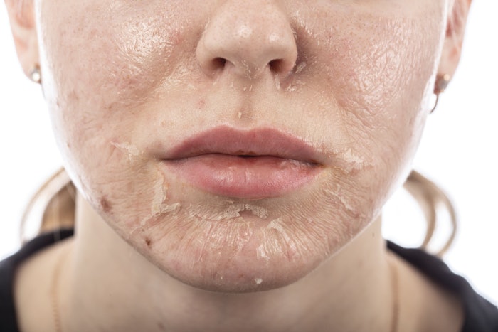 Chemical peels are a staple in skin care, but the kind of peel and your technique all comes down to your client's needs.