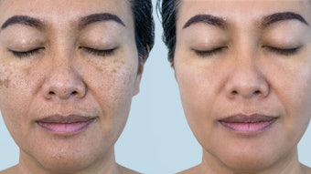 Wonder why you don't see hydroquinone around anymore? There are plenty of safer alternatives to work with when peeling. Make sure you check with your brand to know exactly what you're using.