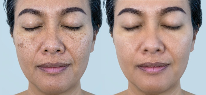 Wonder why you don't see hydroquinone around anymore? There are plenty of safer alternatives to work with when peeling. Make sure you check with your brand to know exactly what you're using.