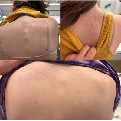 Results after using Perfect B3 for 4 weeks.