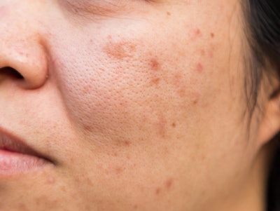 Azelaic acid targets acne-causing bacteria, unclogs pores and reduces inflammation.
