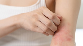 Having so many people afflicted by sensitive skin means a growing demand for gentle, more specialized products.