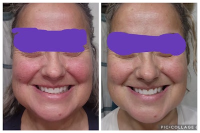 Cortisol face, before (left) and after (right) an appointment.