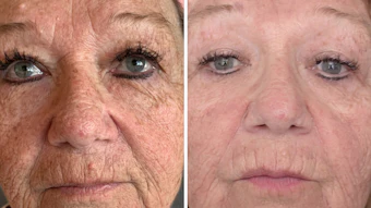 Results Courtesy Of Jeanette Marie Medical Esthetician In Wyandotte Mi