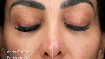 Before and after results from using PCA Skin's Acne Prebiotic Gel Cleanser.